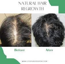Natural Hair Regrowth